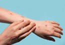 Confirmaron un nuevo caso de Mpox: ¿qué es y cómo se contagia?