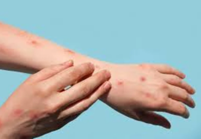 Confirmaron un nuevo caso de Mpox: ¿qué es y cómo se contagia?